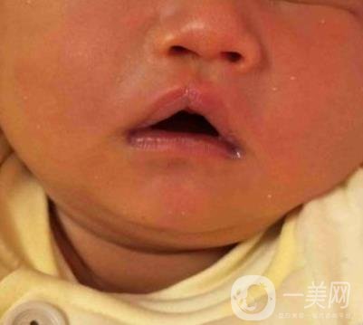 昆明醫(yī)科大學第一附屬醫(yī)院整形科價格表，內(nèi)附兔唇矯正案例