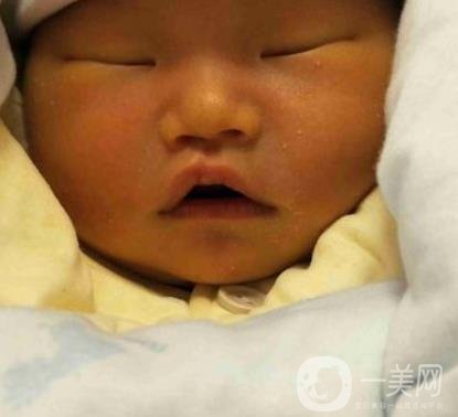 昆明醫(yī)科大學第一附屬醫(yī)院整形科價格表，內(nèi)附兔唇矯正案例