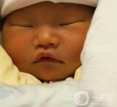 昆明醫(yī)科大學第一附屬醫(yī)院整形科價格表，內(nèi)附兔唇矯正案例