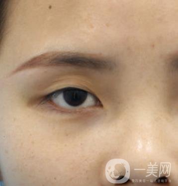 西安交通大學(xué)附屬醫(yī)院整形美容科價(jià)格表和雙眼皮案例一覽