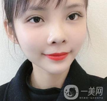 西安交通大學(xué)附屬醫(yī)院整形美容科價(jià)格表和雙眼皮案例一覽