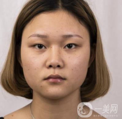 西安市中心醫(yī)院整形科價格表，內(nèi)附韓悅雙眼皮真人案例