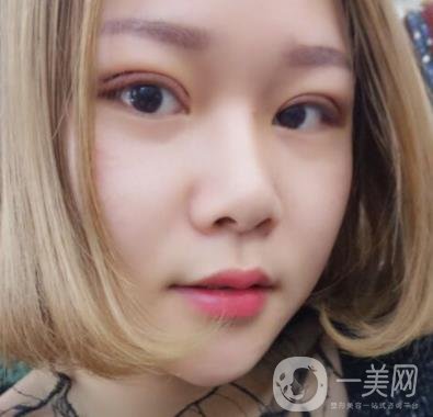 西安市中心醫(yī)院整形科價格表，內(nèi)附韓悅雙眼皮真人案例