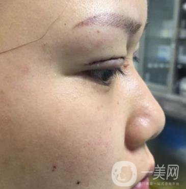 西安市中心醫(yī)院整形科價格表，內(nèi)附韓悅雙眼皮真人案例