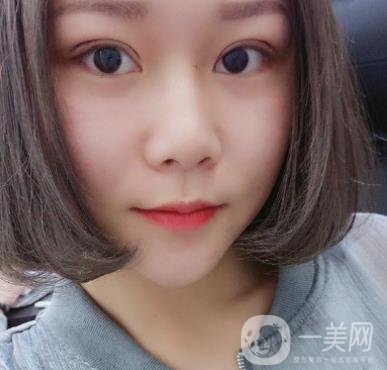 西安市中心醫(yī)院整形科價格表，內(nèi)附韓悅雙眼皮真人案例