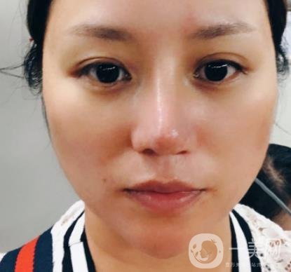 張掖市人民醫(yī)院美容整形科價格表，附眼袋切除*果圖