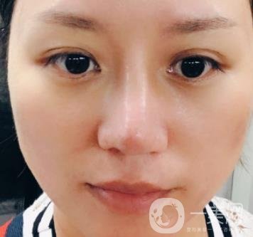 張掖市人民醫(yī)院美容整形科價格表，附眼袋切除*果圖