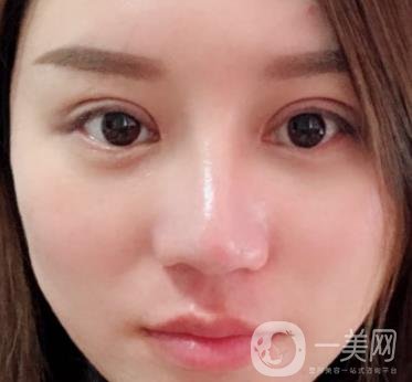 張掖市人民醫(yī)院美容整形科價格表，附眼袋切除*果圖