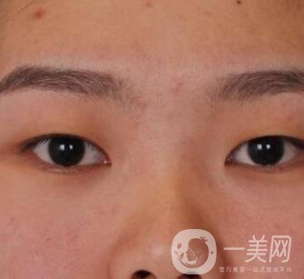 北京醫(yī)院整形項目2020年價格表一覽，內(nèi)附錢文江開眼角案例