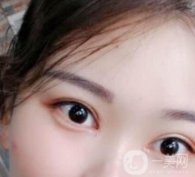 北京醫(yī)院整形項目2020年價格表一覽，內(nèi)附錢文江開眼角案例