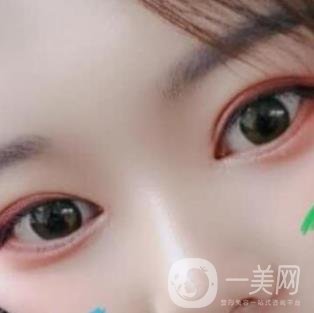 北京醫(yī)院整形項目2020年價格表一覽，內(nèi)附錢文江開眼角案例