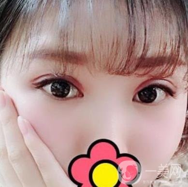 甘肅省人民醫(yī)院割雙眼皮怎么樣？附整形價(jià)格表及真人案例