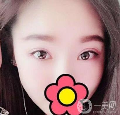 甘肅省人民醫(yī)院割雙眼皮怎么樣？附整形價(jià)格表及真人案例