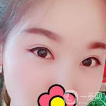 甘肅省人民醫(yī)院割雙眼皮怎么樣？附整形價(jià)格表及真人案例