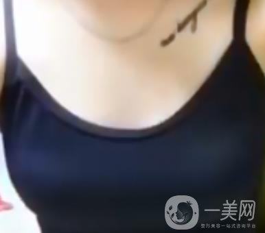 廣東省第二人民醫(yī)院隆胸手術(shù)多少錢？羅盛康案例？附整形價(jià)格表