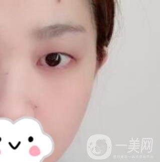 湖南省人民醫(yī)院割雙眼皮要多少錢？整形價(jià)格表一覽