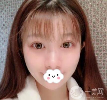 湖南省人民醫(yī)院割雙眼皮要多少錢？整形價(jià)格表一覽