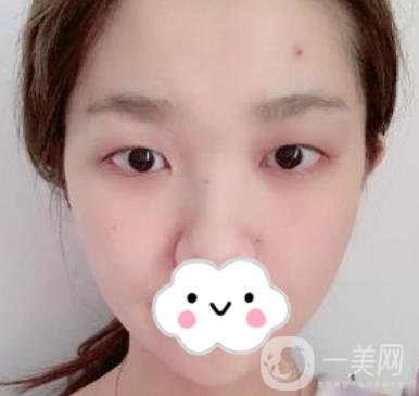 湖南省人民醫(yī)院割雙眼皮要多少錢？整形價(jià)格表一覽