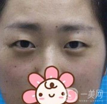 秦皇島人民醫(yī)院雙眼皮怎么樣？附整形價(jià)格表及案例圖
