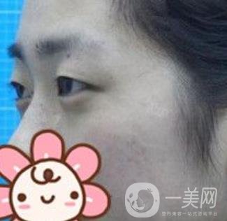 秦皇島人民醫(yī)院雙眼皮怎么樣？附整形價(jià)格表及案例圖