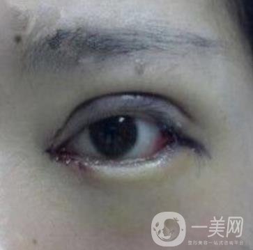 秦皇島人民醫(yī)院雙眼皮怎么樣？附整形價(jià)格表及案例圖