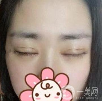秦皇島人民醫(yī)院雙眼皮怎么樣？附整形價(jià)格表及案例圖