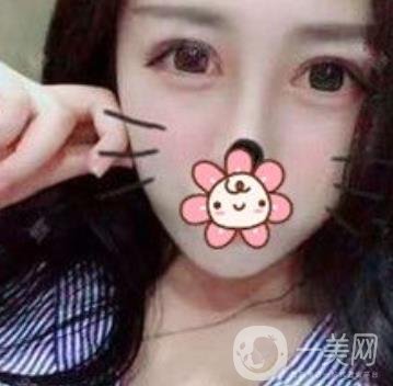 秦皇島人民醫(yī)院雙眼皮怎么樣？附整形價(jià)格表及案例圖