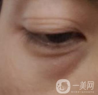 寶雞市人民醫(yī)院去眼袋