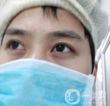 寶雞市人民醫(yī)院去眼袋