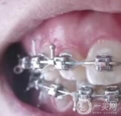 泉州人民醫(yī)院整牙