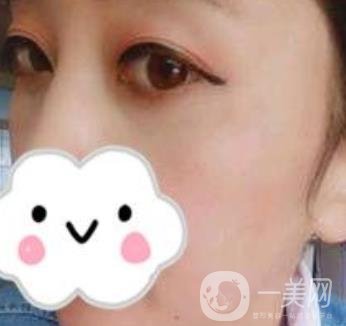 第九人民醫(yī)院去眼袋