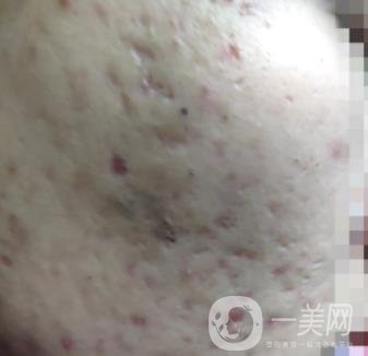 綿陽(yáng)中心醫(yī)院整形美容科祛痘坑怎么樣？?jī)r(jià)格表及術(shù)后*果分享