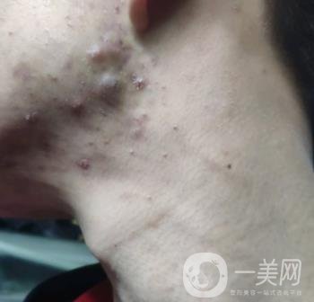 綿陽(yáng)中心醫(yī)院整形美容科祛痘坑怎么樣？?jī)r(jià)格表及術(shù)后*果分享