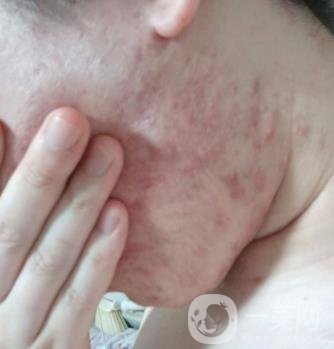 綿陽(yáng)中心醫(yī)院整形美容科祛痘坑怎么樣？?jī)r(jià)格表及術(shù)后*果分享