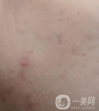 綿陽(yáng)中心醫(yī)院整形美容科祛痘坑怎么樣？?jī)r(jià)格表及術(shù)后*果分享