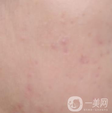 綿陽(yáng)中心醫(yī)院整形美容科祛痘坑怎么樣？?jī)r(jià)格表及術(shù)后*果分享