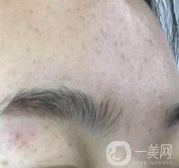 南京省中醫(yī)院整形美容科祛黃褐斑多少錢？?jī)r(jià)格表及案例詳情一覽