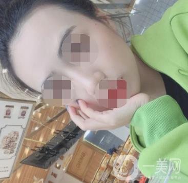 南京省中醫(yī)院整形美容科祛黃褐斑多少錢？?jī)r(jià)格表及案例詳情一覽