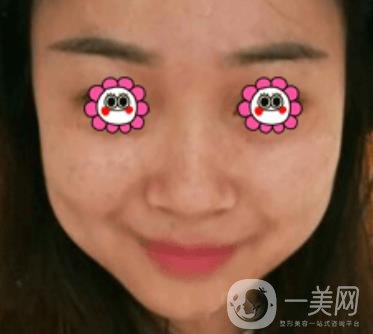 岳陽(yáng)市第一人民醫(yī)院整形美容科祛斑好嗎？?jī)r(jià)格表和案例日記分享