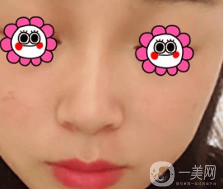 岳陽(yáng)市第一人民醫(yī)院整形美容科祛斑好嗎？?jī)r(jià)格表和案例日記分享