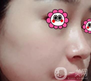 岳陽(yáng)市第一人民醫(yī)院整形美容科祛斑好嗎？?jī)r(jià)格表和案例日記分享