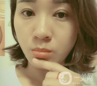 中山一院整形科價(jià)格表,及切腋臭日記一覽