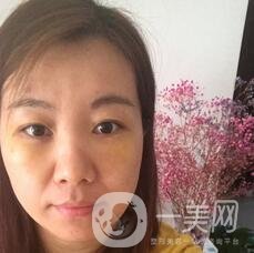 贛州市人民醫(yī)院整形科價格表，附祛眼袋案例分享