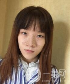 南昌二附院整形科價(jià)格表2020，附肋軟骨隆鼻整形案例