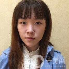 南昌二附院整形科價(jià)格表2020，附肋軟骨隆鼻整形案例