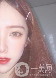 南昌二附院整形科價(jià)格表2020，附肋軟骨隆鼻整形案例