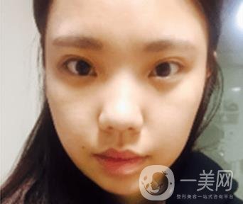 西安唐都醫(yī)院價(jià)格表價(jià)目表，內(nèi)附吳瓊隆鼻整形日記