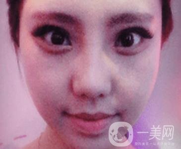 西安唐都醫(yī)院價(jià)格表價(jià)目表，內(nèi)附吳瓊隆鼻整形日記