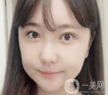 廣州博仕整形醫(yī)院做鼻子多少錢?價格表和整形恢復(fù)日記一覽