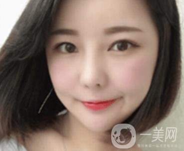 廣州博仕整形醫(yī)院做鼻子多少錢?價格表和整形恢復(fù)日記一覽